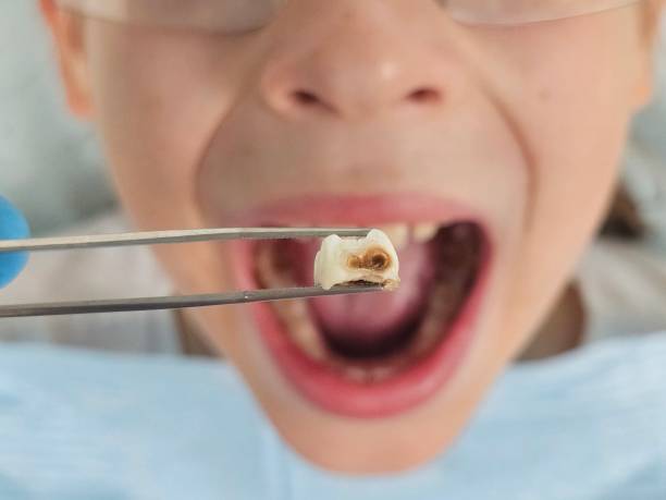 Best Emergency Treatment for Dental Infections or Abscesses in Floris, VA